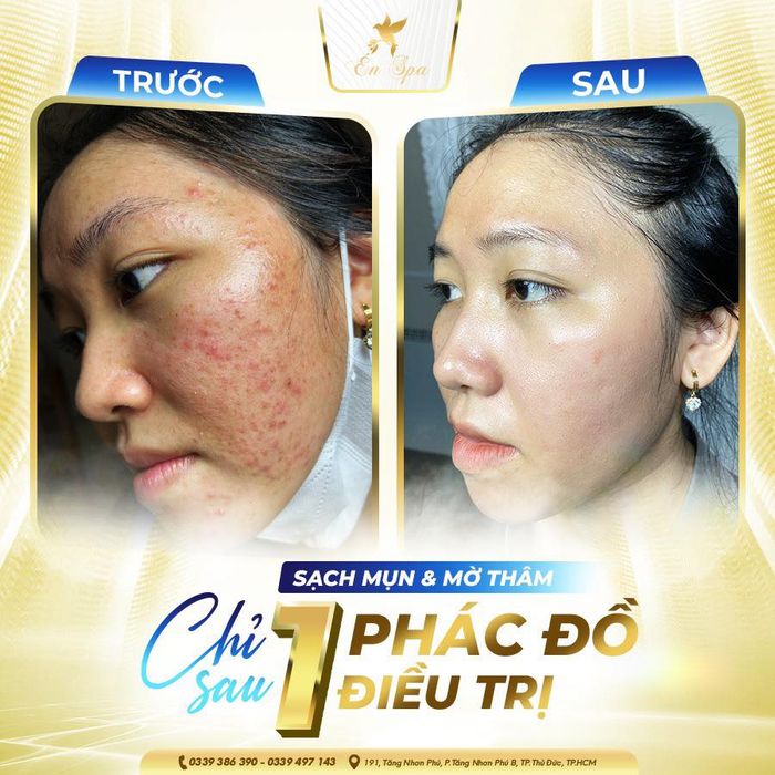 Hình ảnh quy trình điều trị mụn chuyên nghiệp tại Én Spa Thủ Đức