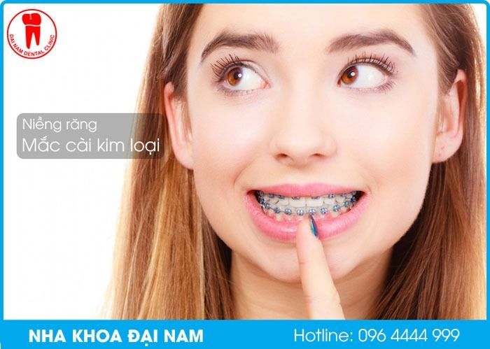 Quy trình niềng răng chuyên nghiệp tại Nha Khoa Đại Nam (Ảnh 2)