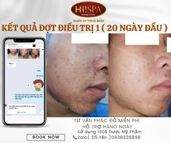 Bộ sưu tập hình ảnh trị liệu tại Hi Spa Beauty Center - Minh chứng cho sự khác biệt từ đôi bàn tay vàng