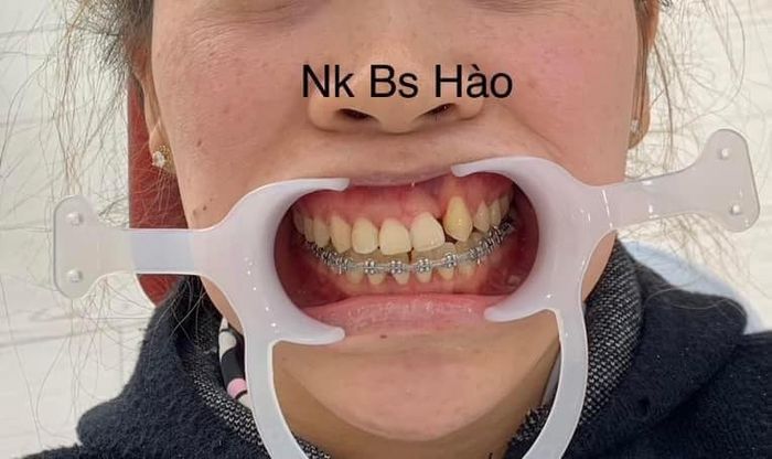 Hình ảnh thực tế Nha khoa BS Hào (Ảnh 2)