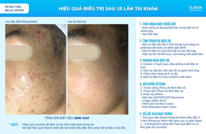 Bộ sưu tập hình ảnh kết quả điều trị tại O2 SKIN - Minh chứng cho hiệu quả trị mụn vượt trội