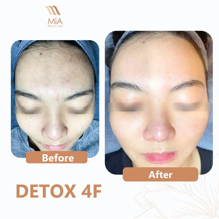 Hình ảnh quy trình điều trị mụn chuyên nghiệp tại MiA Beauty Spa