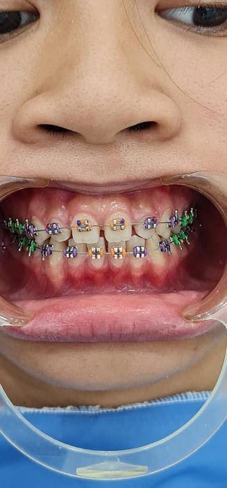 Quy trình niềng răng chuyên nghiệp tại Nha Khoa Tâm Đức (Ảnh 2)