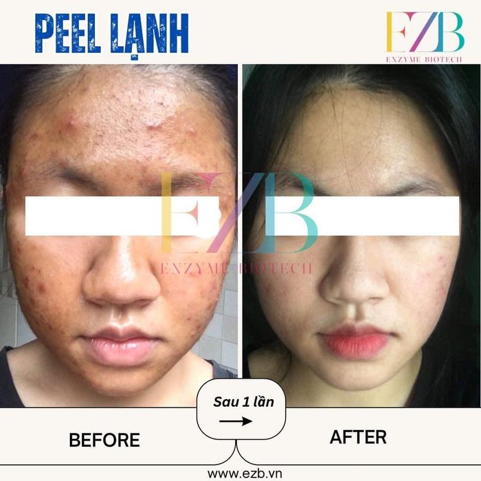 Hình ảnh quy trình điều trị mụn chuẩn y khoa tại H'2 Spa & Clinic