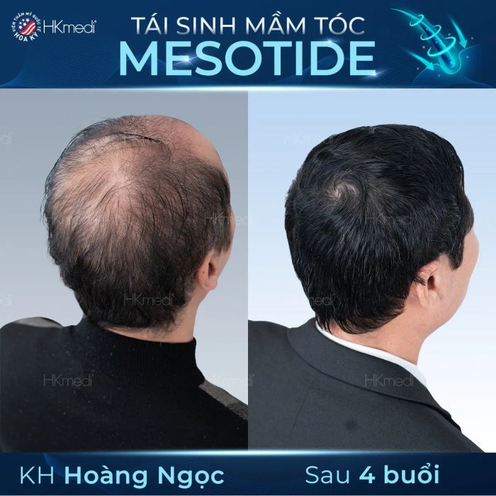 Hình ảnh Phòng Khám Chuyên Khoa Da Liễu Hoa Kỳ - Công nghệ Mesotide hiện đại