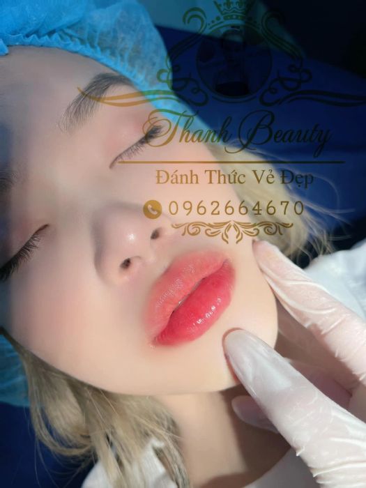 Quy trình tiêm Filler chuẩn y khoa tại Thanh Beauty (Anna Spa)