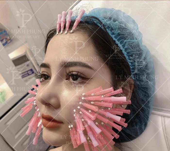 Quy trình tiêm Filler chuẩn y khoa tại Viện Thẩm Mỹ Lý Minh Phụng