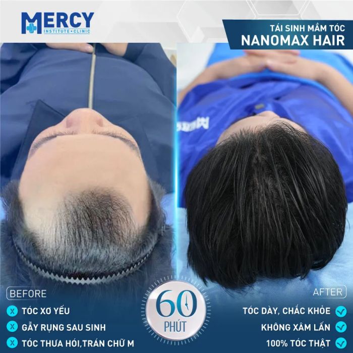 Hình ảnh Phòng Khám Da Liễu Mercy - Công nghệ Nanomax Hair Plus hiện đại
