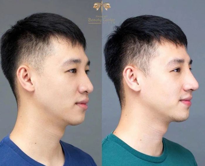Hình ảnh thực tế quy trình nâng mũi tại Viện Tấm