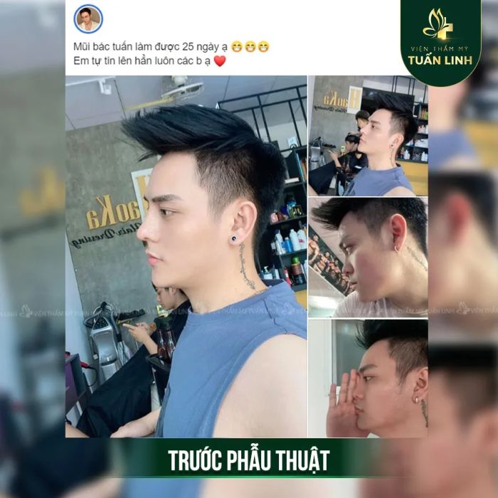 Hình ảnh thực tế quy trình nâng mũi tại Viện Thẩm Mỹ Tuấn Linh