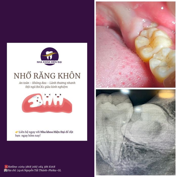 Hình ảnh quy trình nhổ răng khôn chuyên nghiệp tại Nha Khoa Hiện Đại