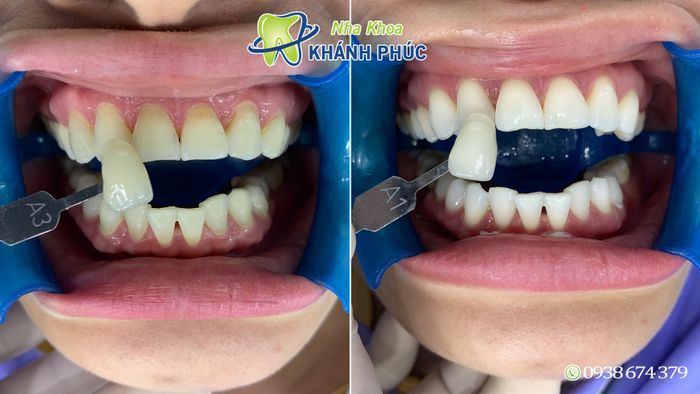 Hình ảnh thực tế tại Nha Khoa Khánh Phúc