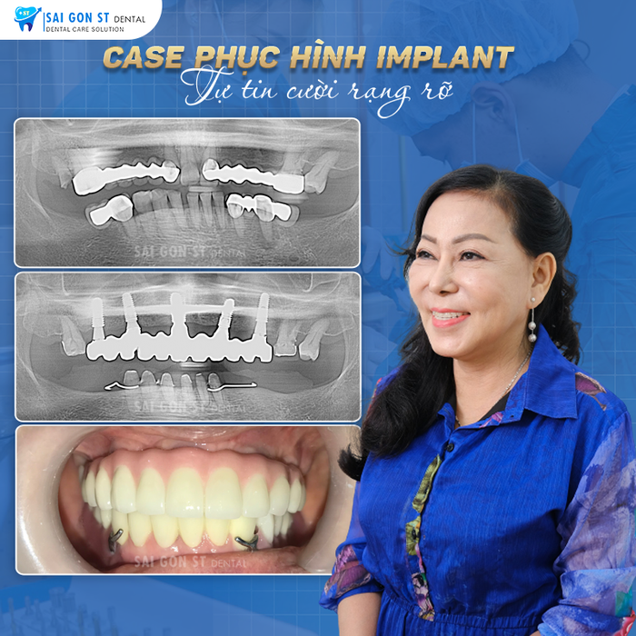 Hình ảnh thực tế Nha khoa Sài Gòn ST