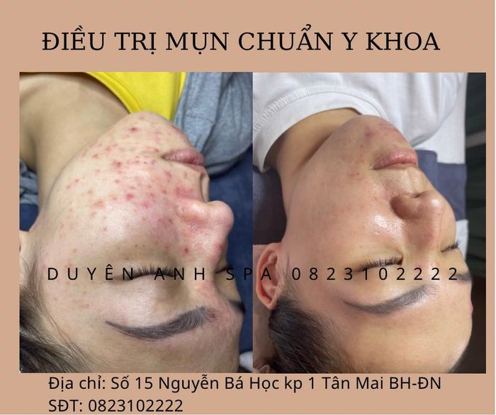 Duyên Trần Spa - Đặc trị về da ảnh 2