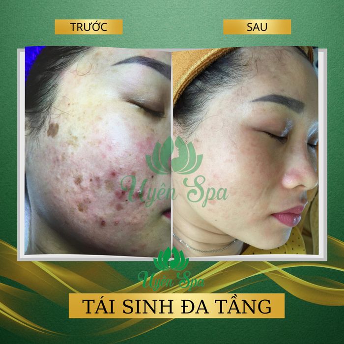 Hoài Anh Hoa Chương - Trị Mụn Biên Hòa ảnh 2
