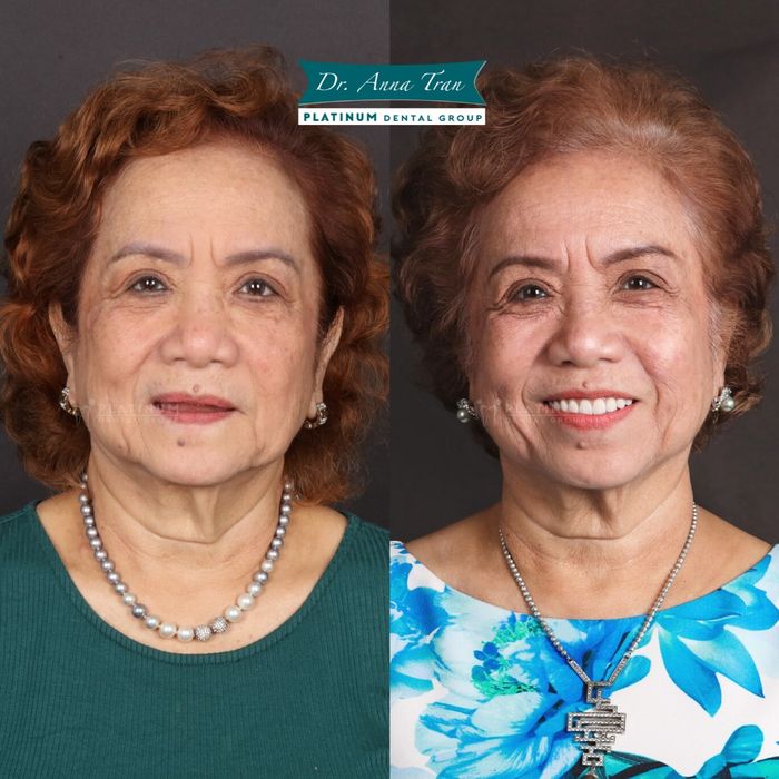 Hình ảnh điều trị tại Platinum Dental Group