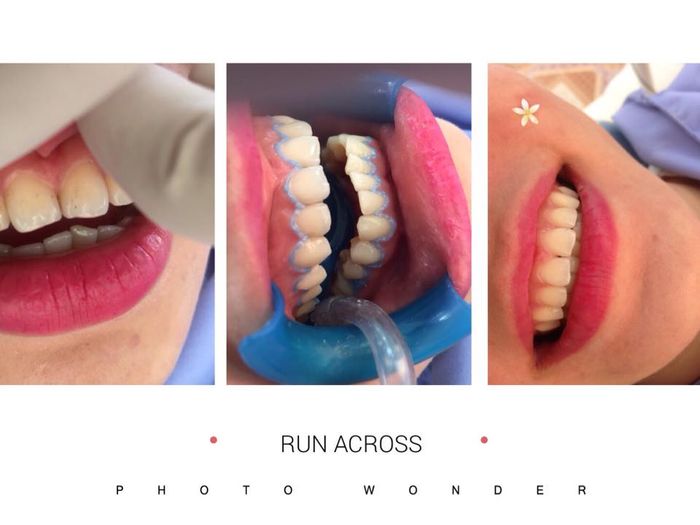 Quy trình tẩy trắng răng chuẩn y khoa tại Việt Tiệp