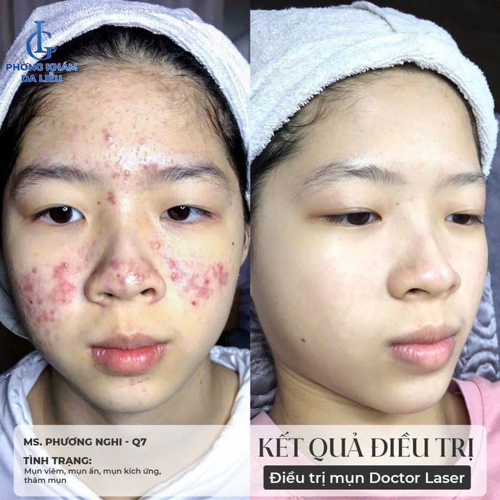 ket-qua-dieu-tri-mun.png