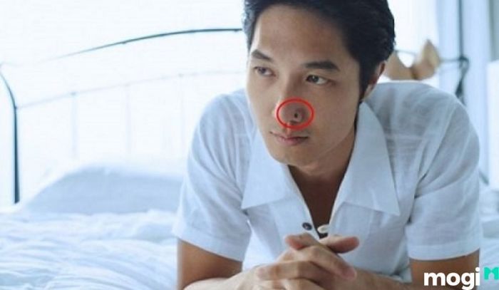 Nốt ruồi ở cánh mũi