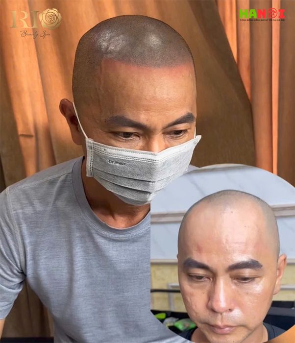 Xăm chân tóc – Giải pháp tối ưu cho tóc thưa, hói, phù hợp cho cả nam và nữ
