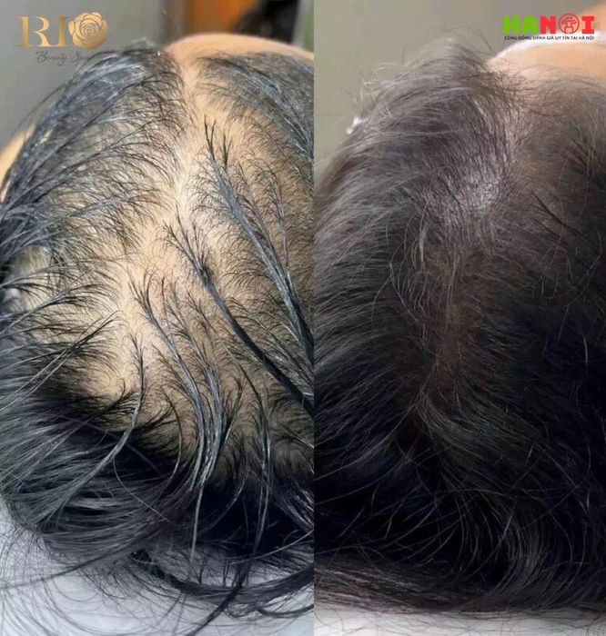 Xăm chân tóc – Giải pháp cải thiện tóc thưa cho cả nam và nữ