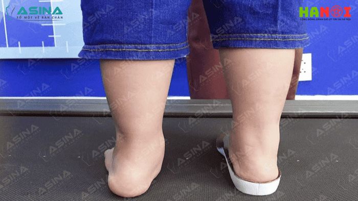 ban-chan-bet-o-tre-chuyen-gia-canh-bao-3-he-qua-nghiem-trong-neu-khong-can-thiep-kip-thoi-2-Mytour