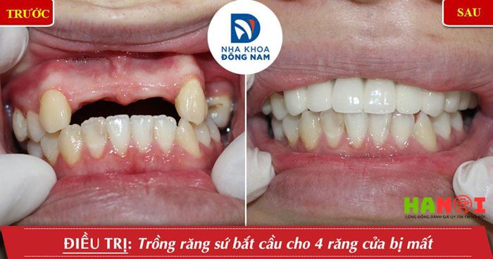 Lam-cau-rang-su-co-ton-kem-khong-tu-van-tu-chuyen-gia-nha-khoa-5-Mytour