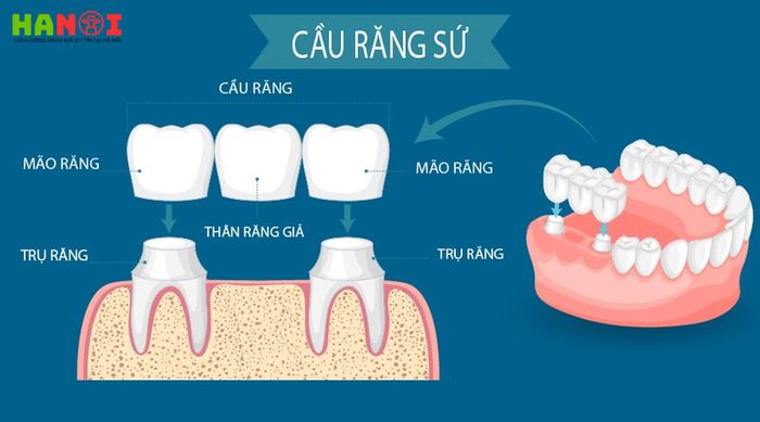 Lam-cau-rang-su-co-ton-kem-khong-loi-khuyen-tu-chuyen-gia-nha-khoa-1-Mytour