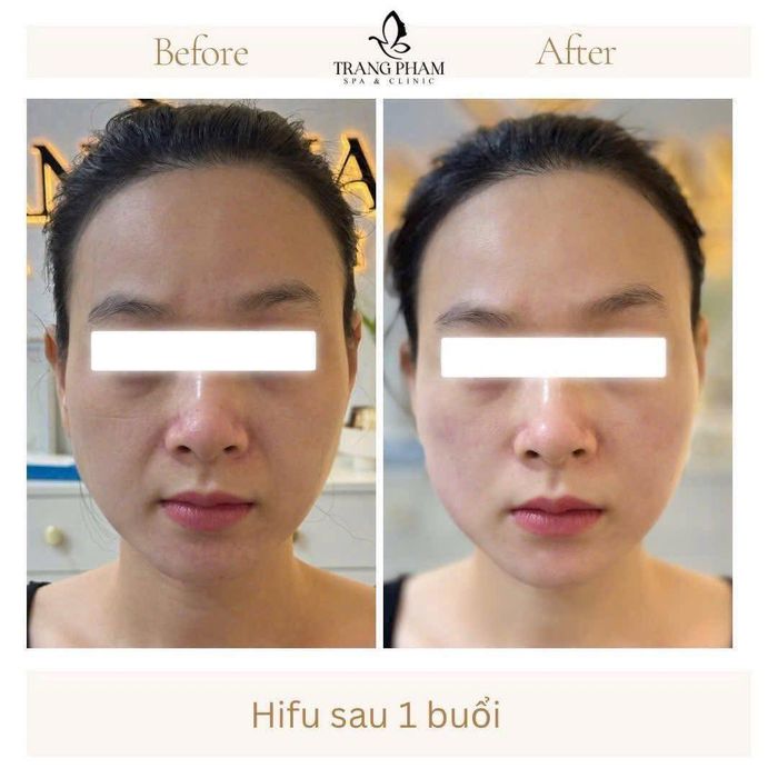 Hình ảnh dịch vụ tại Trang Phạm Spa & Clinic