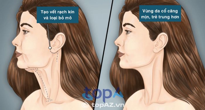 Quy trình thực hiện chuẩn y khoa là yếu tố quan trọng để đảm bảo sự an toàn và hiệu quả trong việc căng da cổ. Việc thực hiện đúng quy trình giúp giảm thiểu rủi ro và biến chứng không mong muốn, đồng thời mang lại kết quả thẩm mỹ tự nhiên và bền vững.