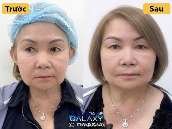 Thẩm mỹ viện Galaxy căng da cổ