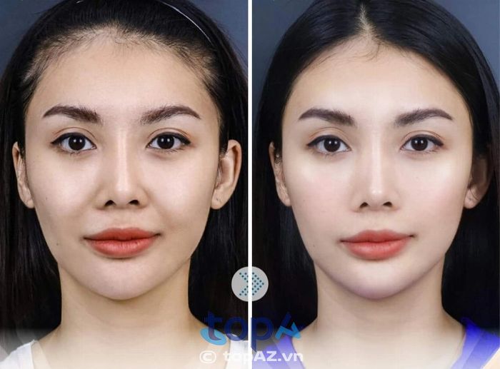 Các địa chỉ uy tín để thực hiện căng chỉ xóa rãnh cười tại TPHCM.