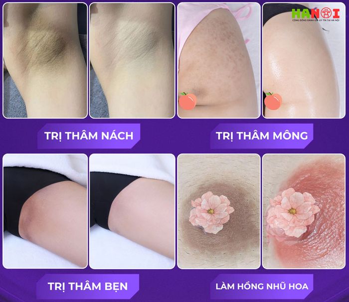 Đánh giá liệu trình trị thâm body tại LG Clinic: Vì sao nhận được nhiều phản hồi tích cực từ khách hàng? - Mytour