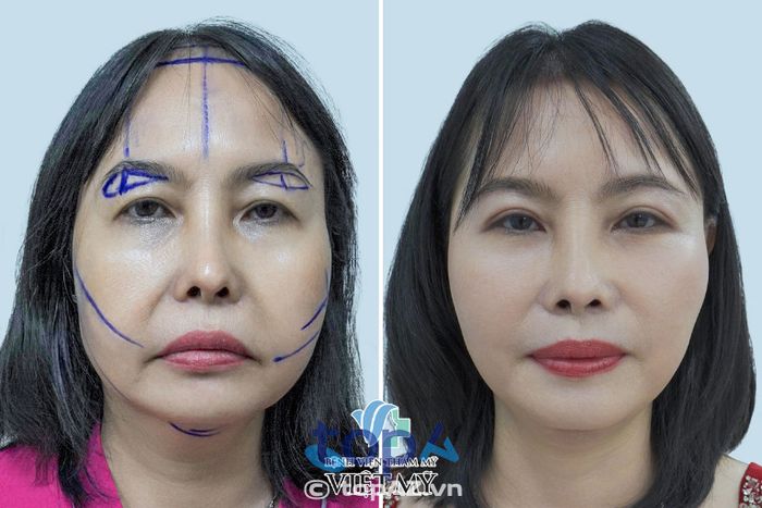 Bệnh viện Thẩm mỹ Việt Mỹ – P. Cầu Ông Lãnh