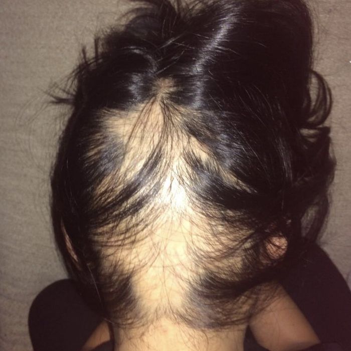 a person with a noticeable bald patch before applying castor oil