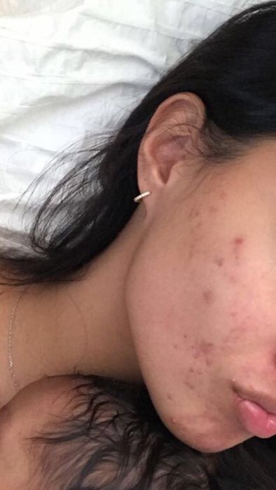 A reviewer with acne along their jawline