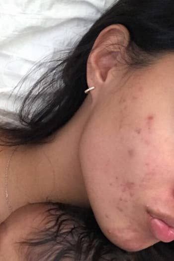 A reviewer with acne along their jawline