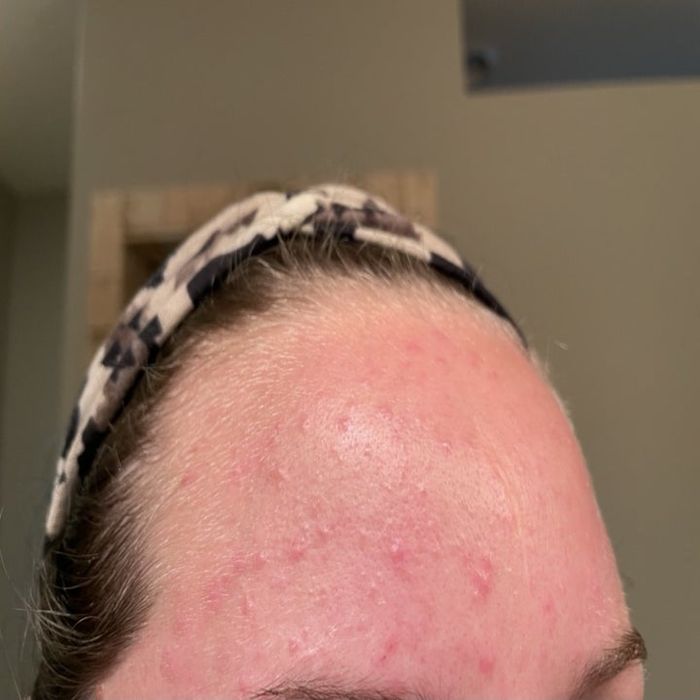A reviewer showing their forehead before applying this product.