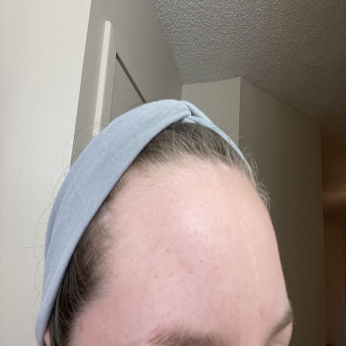 A reviewer showcasing their forehead after using this product.