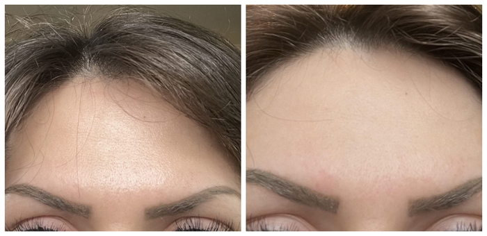The reviewer's oily forehead before using the powder