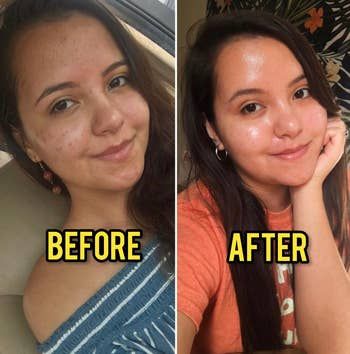 Before-and-after photos showing a reviewer with noticeably reduced acne marks and clearer, glowing skin
