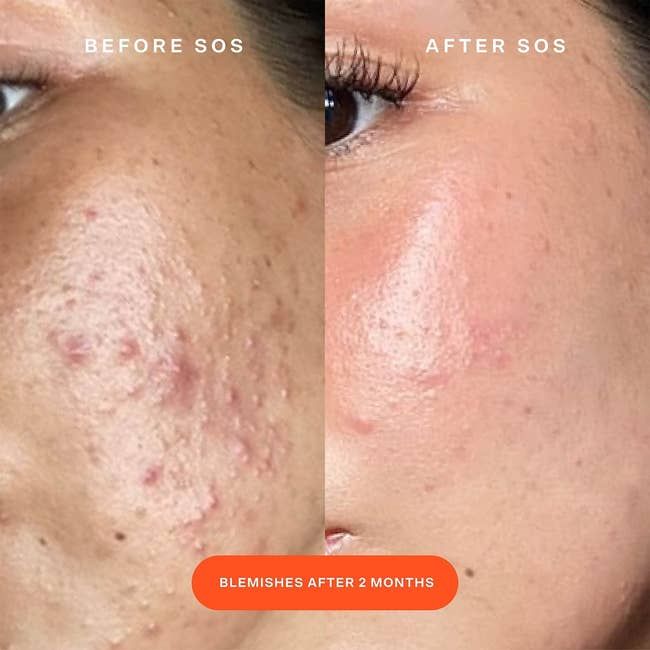 A before-and-after image showing significant improvement in acne and redness after using the spray for 2 months.