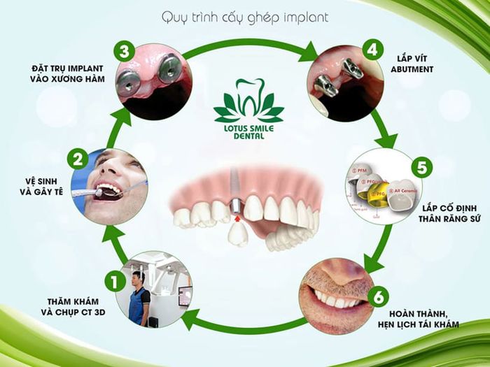 trồng răng implant tại Đà Nẵng