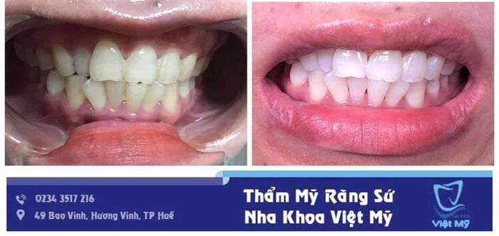 Nha Khoa Việt Mỹ – Chất Lượng Tuyệt Hảo, Giá Cả Phải Chăng
