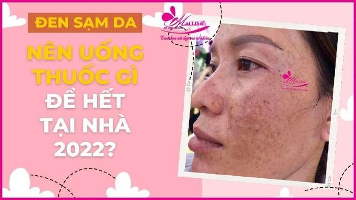 Điều Trị Nám, Tàn Nhang Tại Đà Nẵng