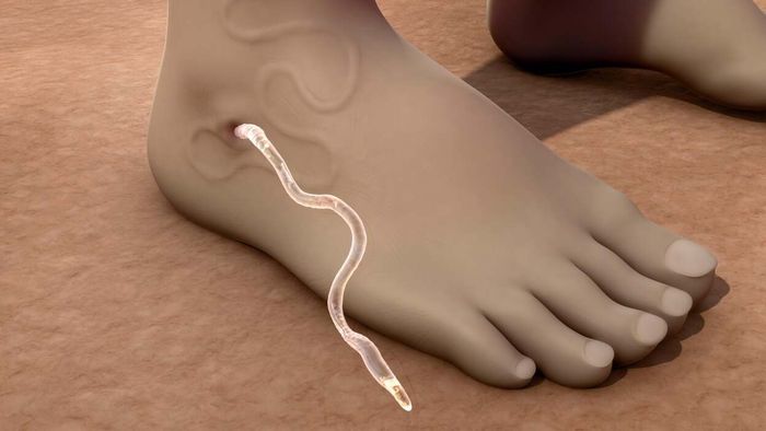 Guinea worm disease