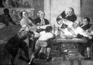 amputation