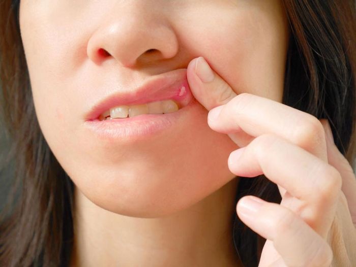 Nhiệt miệng có thể xuất hiện ở bất kỳ đâu trong khoang miệng