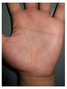 เส้นลายมือขาด