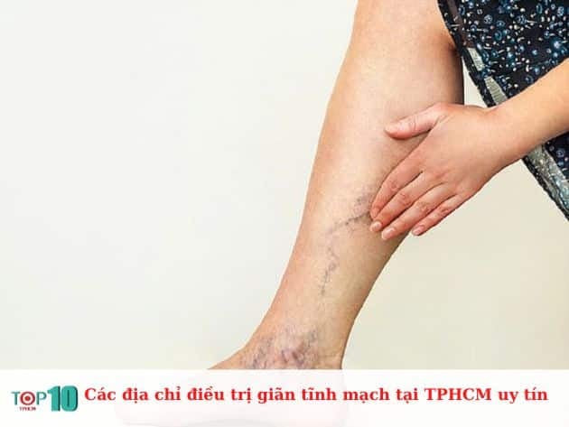 Danh sách các địa chỉ uy tín điều trị giãn tĩnh mạch tại TPHCM